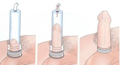 васеъ кардани penis бо истифода аз насос